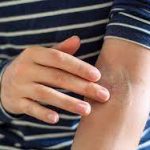 Understanding the Importance of Choosing the Right Eczema Cream for Your Skin