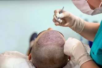 Hair Transplant