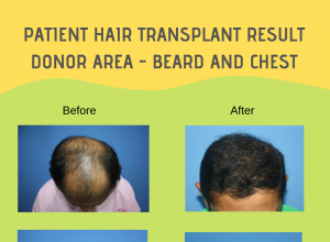 How Do I Know If I Have Enough Donor Hair for a Transplant