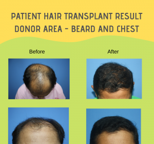 How Do I Know If I Have Enough Donor Hair for a Transplant
