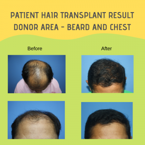 How Do I Know If I Have Enough Donor Hair for a Transplant