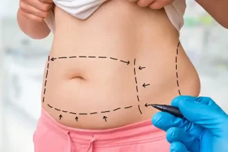Mini Tummy Tuck Recovery