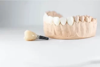 Dental Implants