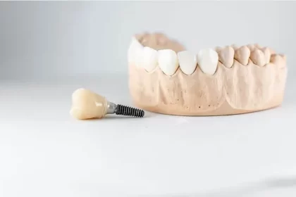 Dental Implants