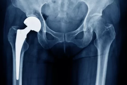 When is Joint Replacement Necessary? Indications and Considerations
