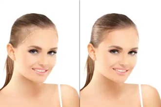 Hair Transplant