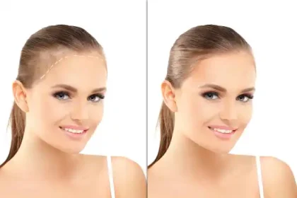 Hair Transplant