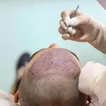 Hair Transplant