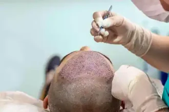 Hair Transplant