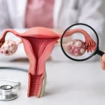 PCOS